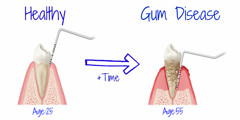 Periodontal Treatments at PERFECT SMILE